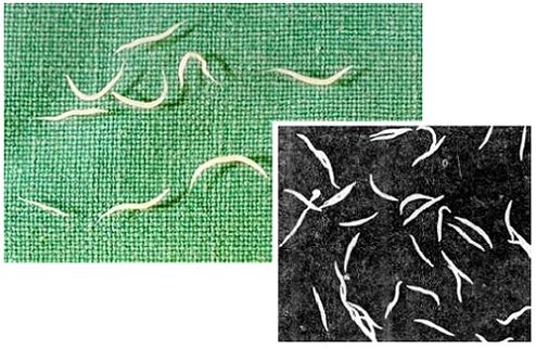 pinworms uit het menselijk lichaam