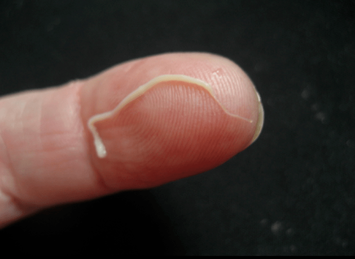 rondwormparasiet van het menselijk lichaam